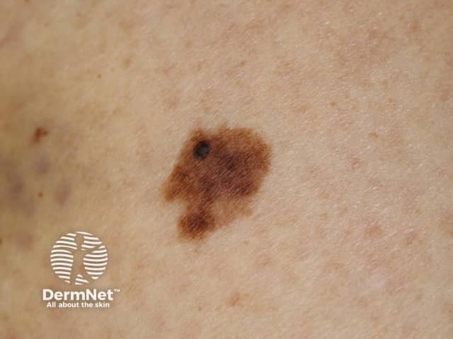 Macro image of superficial spreading melanoma 1