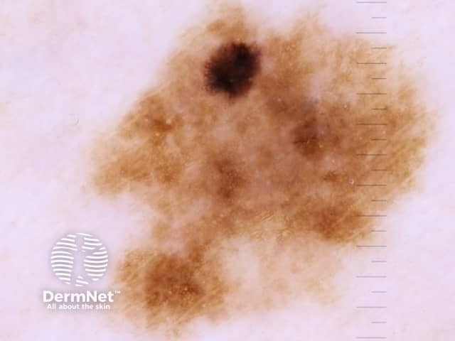 Dermoscopic image of superficial spreading melanoma 1