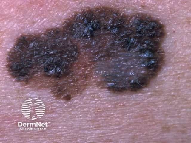 Superficial spreading melanoma