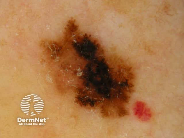 Dermoscopic image of superficial spreading melanoma 6