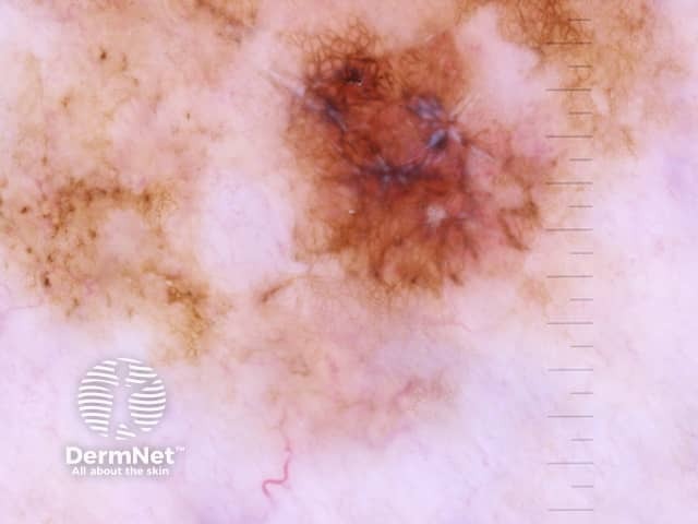 Angulated lines seen on dermoscopy of melanoma