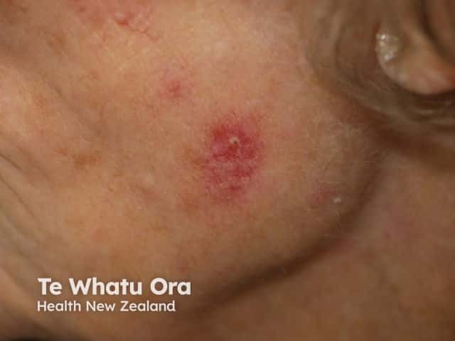 Superficial basal cell carcinoma, face