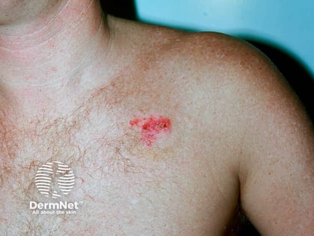 Superficial basal cell carcinoma, chest