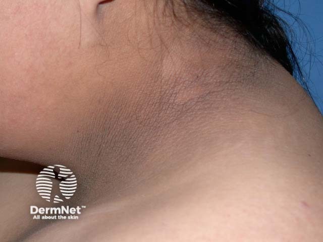 Acanthosis nigricans