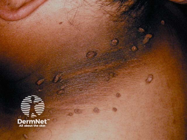 Acanthosis nigricans