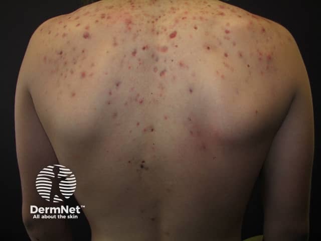 Acne affecting the back images