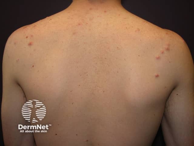 Acne affecting the back images