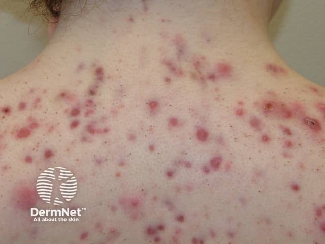 Acne affecting the back images