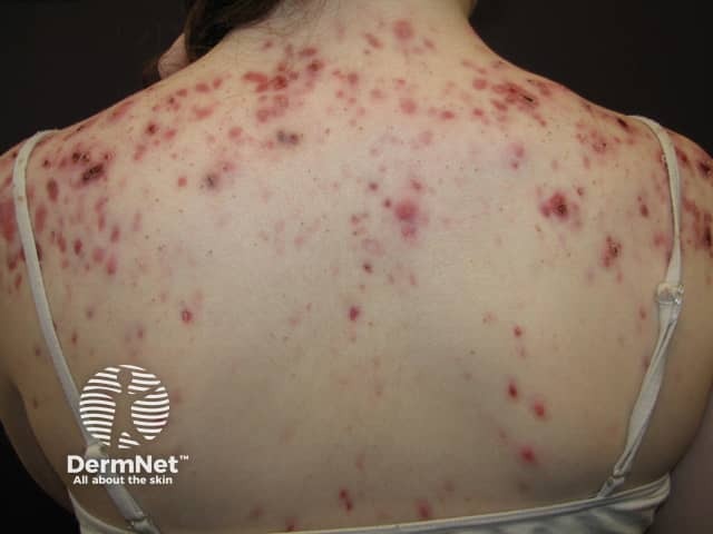 Acne affecting the back images