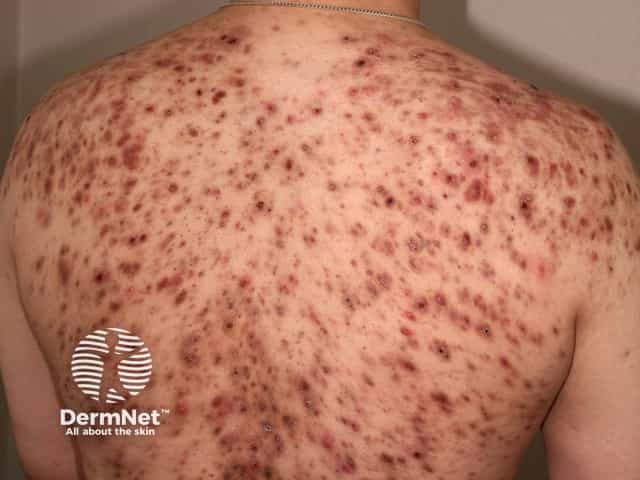 Severe back acne