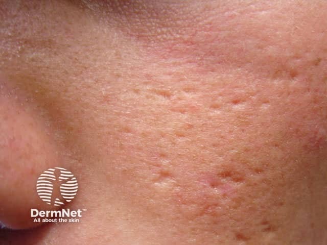 Scarring from infantile acne