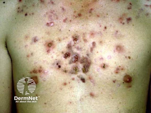 Nodulocystic acne