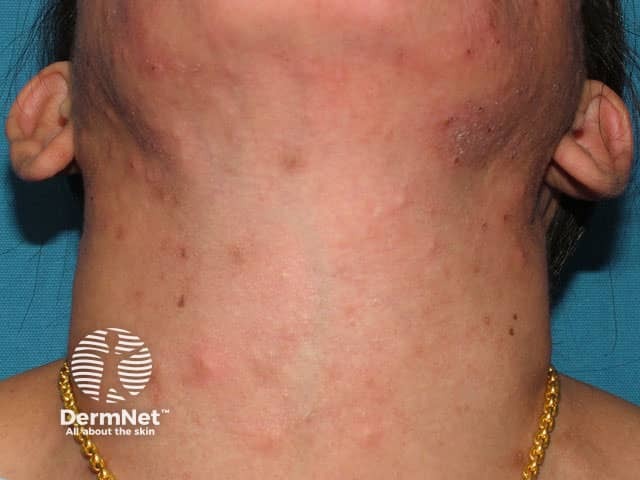 Eosinophilic folliculitis