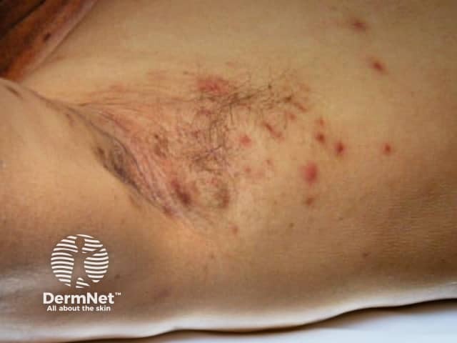 Folliculitis in axilla