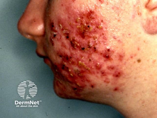 Gram-negative folliculitis