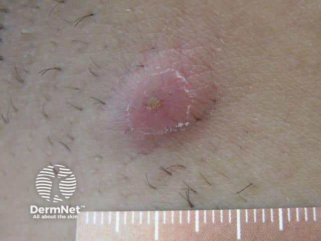 Hidradenitis nodule