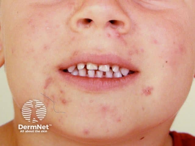 Prepubertal acne