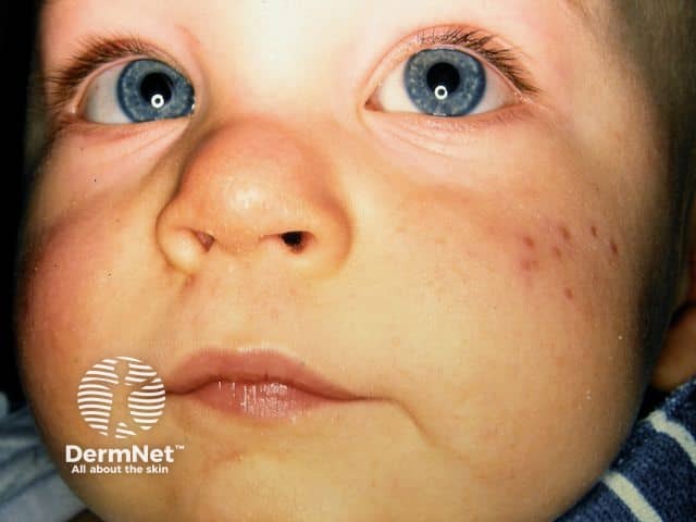 Infantile acne