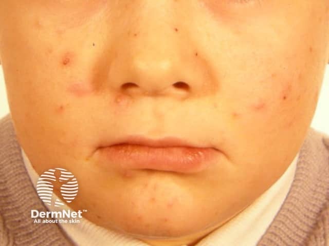 Infantile acne