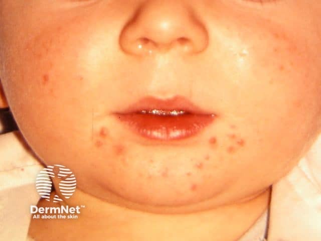 Infantile acne