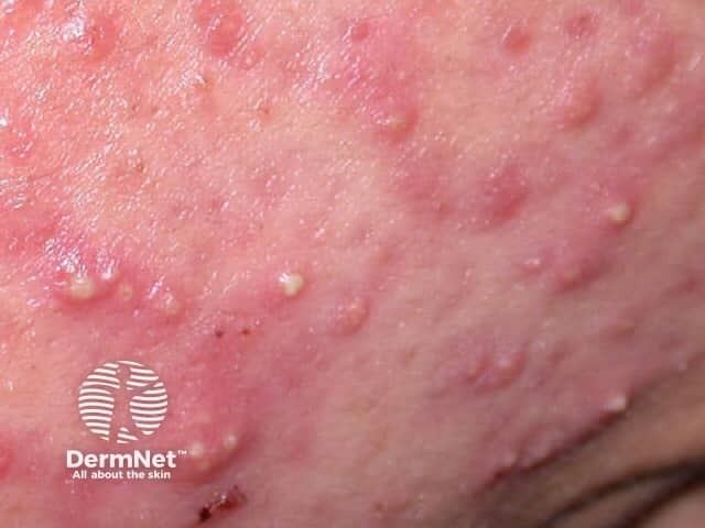 Acne pustules