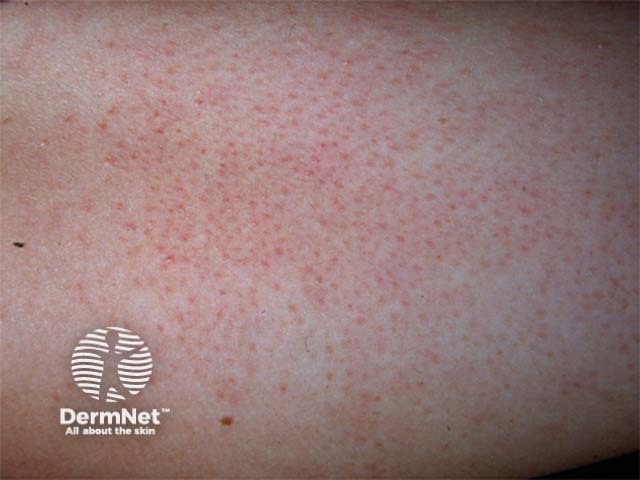 Keratosis pilaris