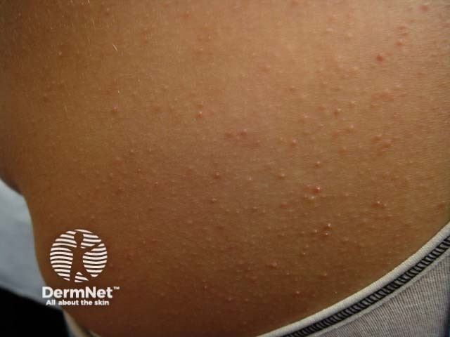 Keratosis pilaris