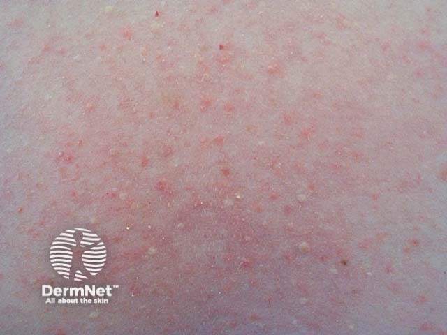 Keratosis pilaris