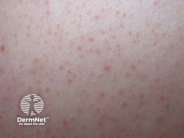 Keratosis pilaris