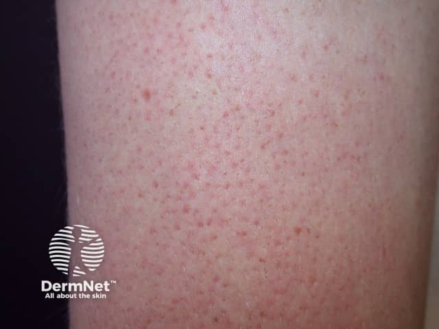 Keratosis pilaris