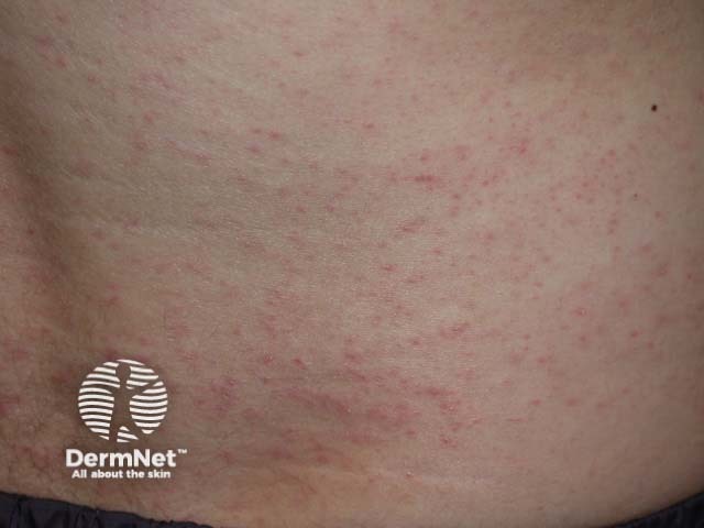 Keratosis pilaris