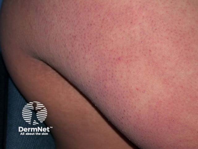 Keratosis pilaris