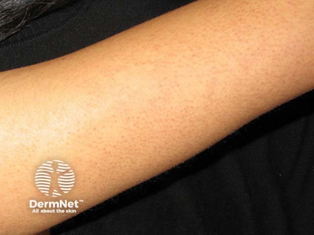 Keratosis pilaris