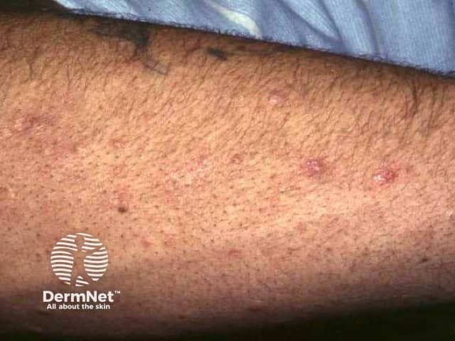 Folliculitis