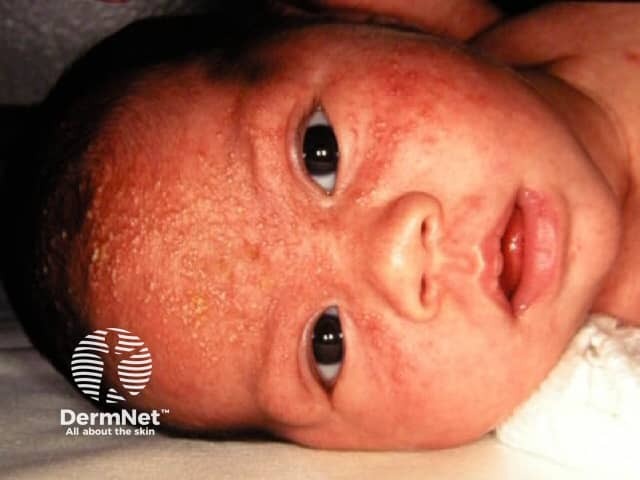 Neonatal cephalic pustulosis