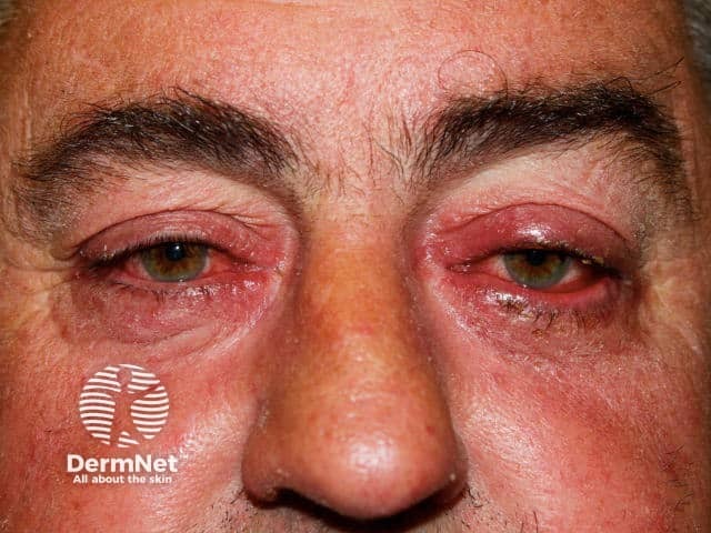 Ocular rosacea