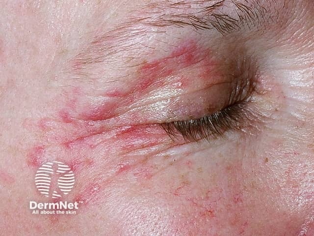 Periocular dermatitis