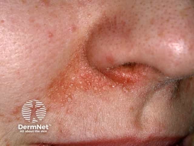 Perioral dermatitis