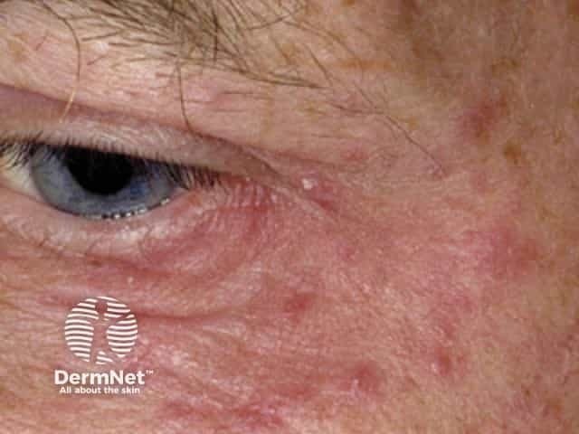 Periocular dermatitis