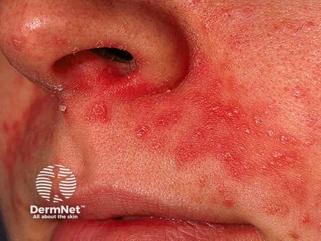 Perioral dermatitis