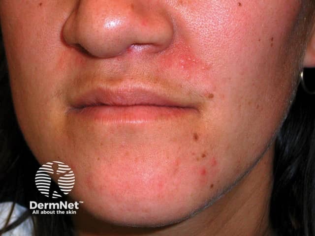 Perioral dermatitis