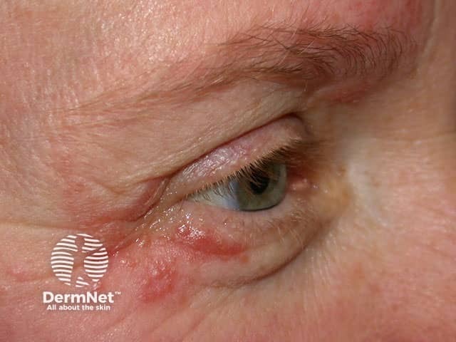 Periocular dermatitis