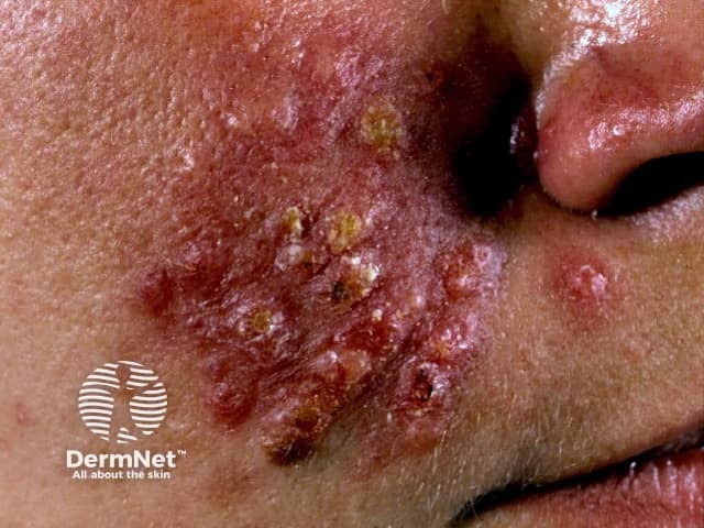 Pyoderma faciale, rosacea fulminans