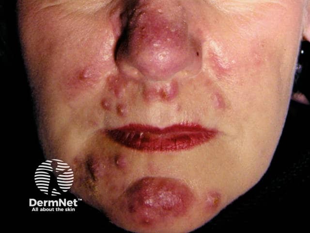 Pyoderma faciale, rosacea fulminans