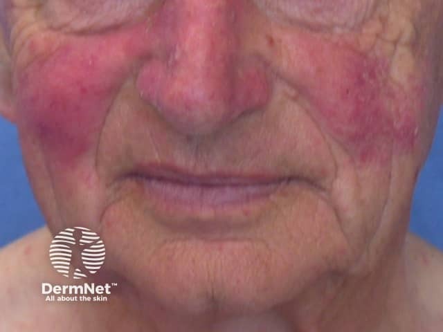 Rosacea