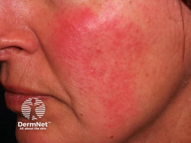 Rosacea