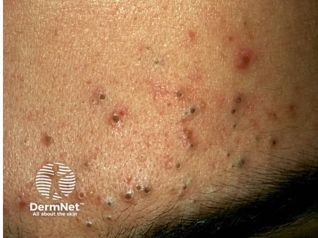 Comedonal acne