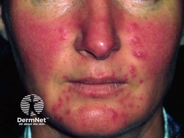 Papulopustular rosacea - usually in an older age group than acne