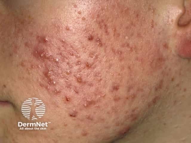 Severe acne