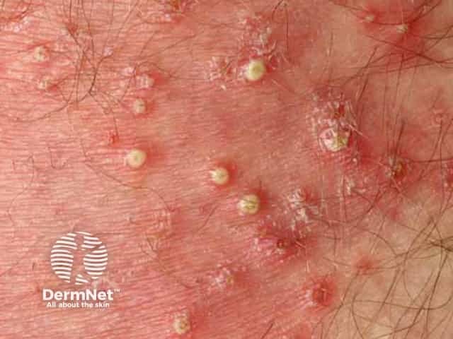 Superficial bacterial folliculitis